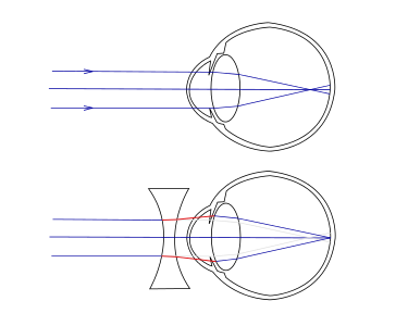 375px-Myopia.svg_