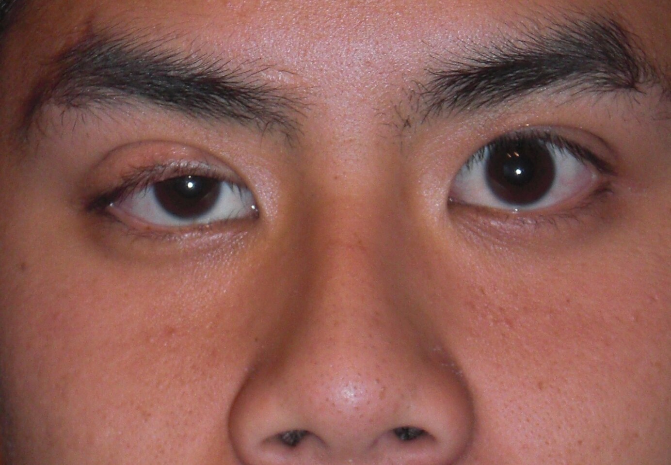 Hangende oogleden (ptosis)