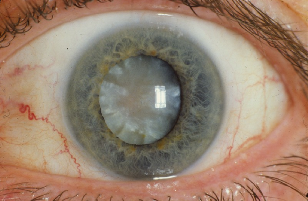 Oog met cataract