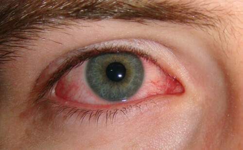 Close-up van een oog met conjunctivitis