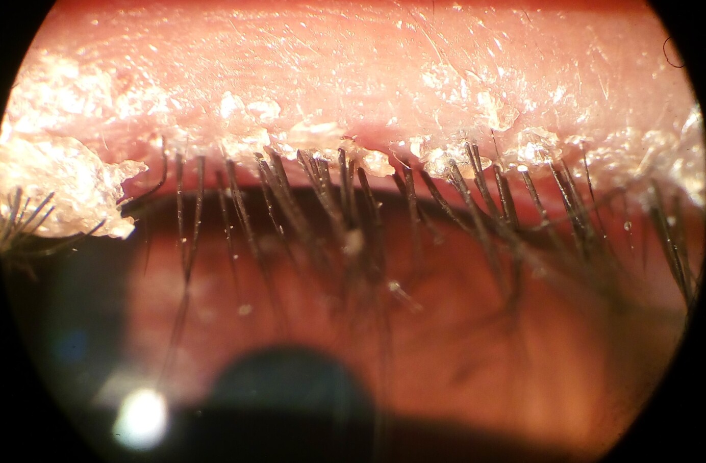 Close-up van anterieure blefaritis