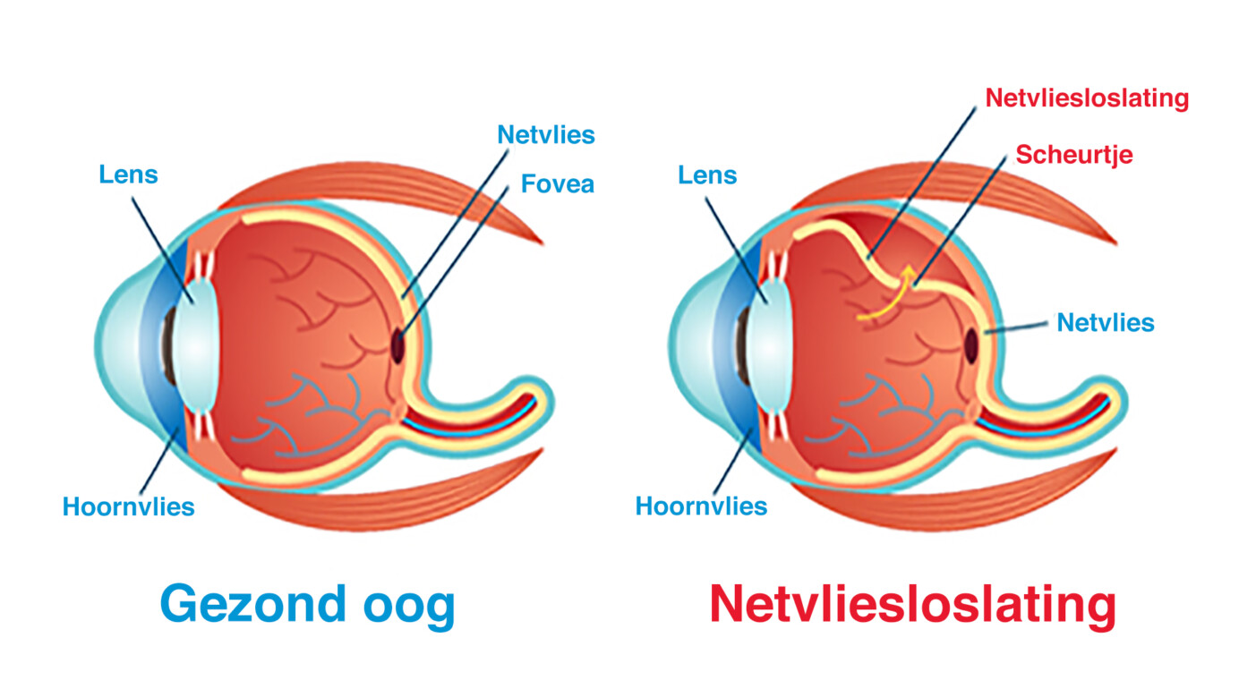 Schematische weergave van een gezond oog en een oog met een netvliesloslating