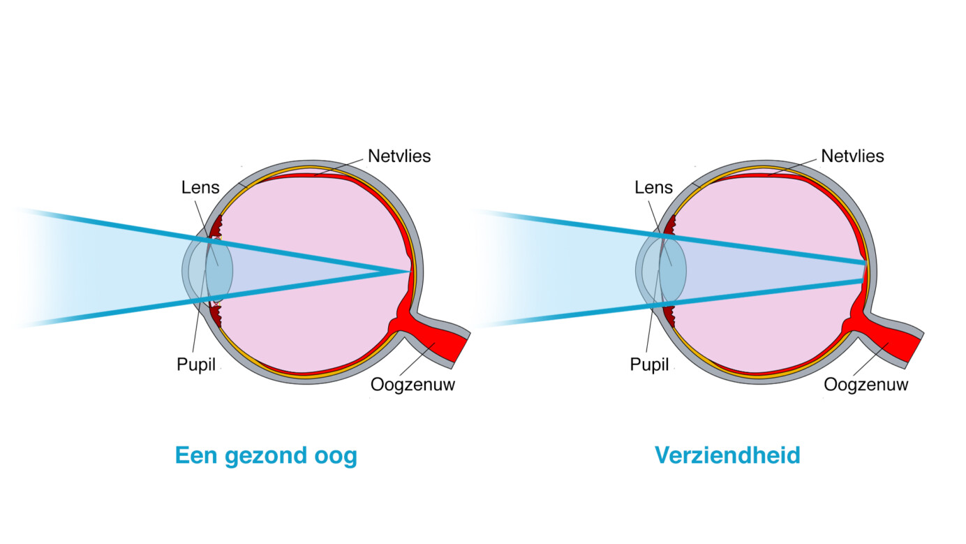 Schematische weergave van een gezond oog en een oog met verziendheid