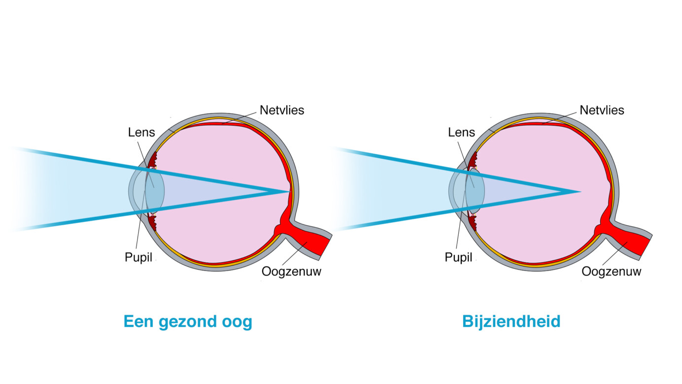 Schematische weergave van een gezond oog en een oog met bijziendheid