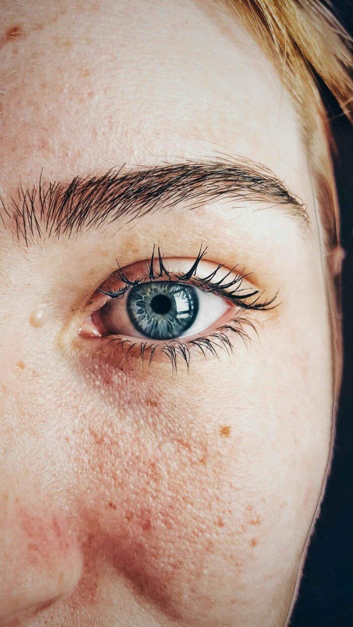 Alles over cornea punctata oogziekte