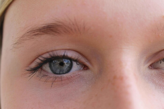 Wat te doen bij een bultje in je oog?