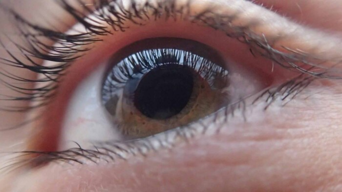Lens verschuift naar zijkant oog